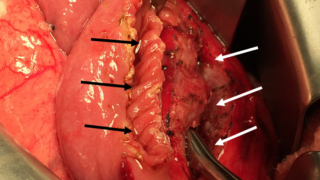 pancreatic-duct-opening